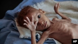 Mtoto mwenye utapiamlo akiwa kituo cha afya cha Aslam, Hajjah, Yemen, Katika Bandari ya Hodeida bahari ya Shamu.